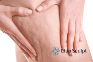 CoolSculpting for Legs: The Innovative Approach to Redefining Your Legs 5 Start your journey today book your coolsculpting treatment Enderby online today!