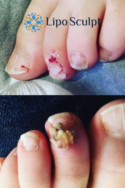 Wart removal customer results from Lipo Sculpt Enderby