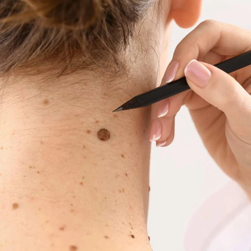 See our lesion removal prices Enderby - call today for a free quote
